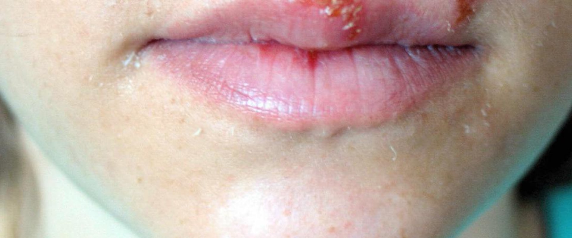 Is Herpes Curable? Understanding the Facts