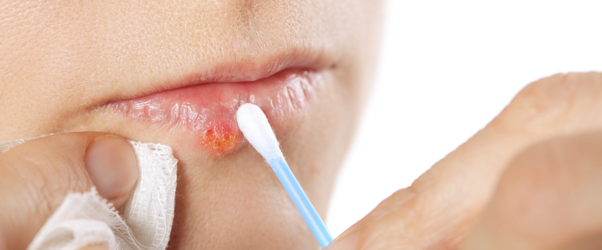 How to Treat Cold Sores: Natural Remedies and Medications