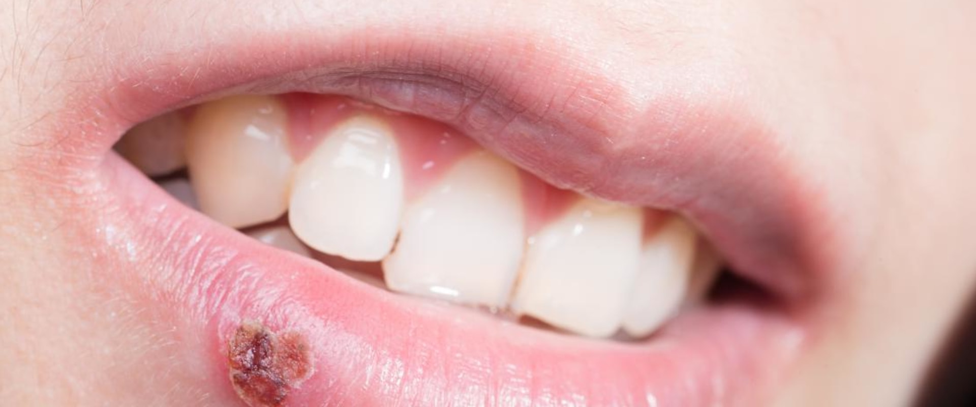 Why Do I Keep Getting Herpes Outbreaks All of a Sudden?
