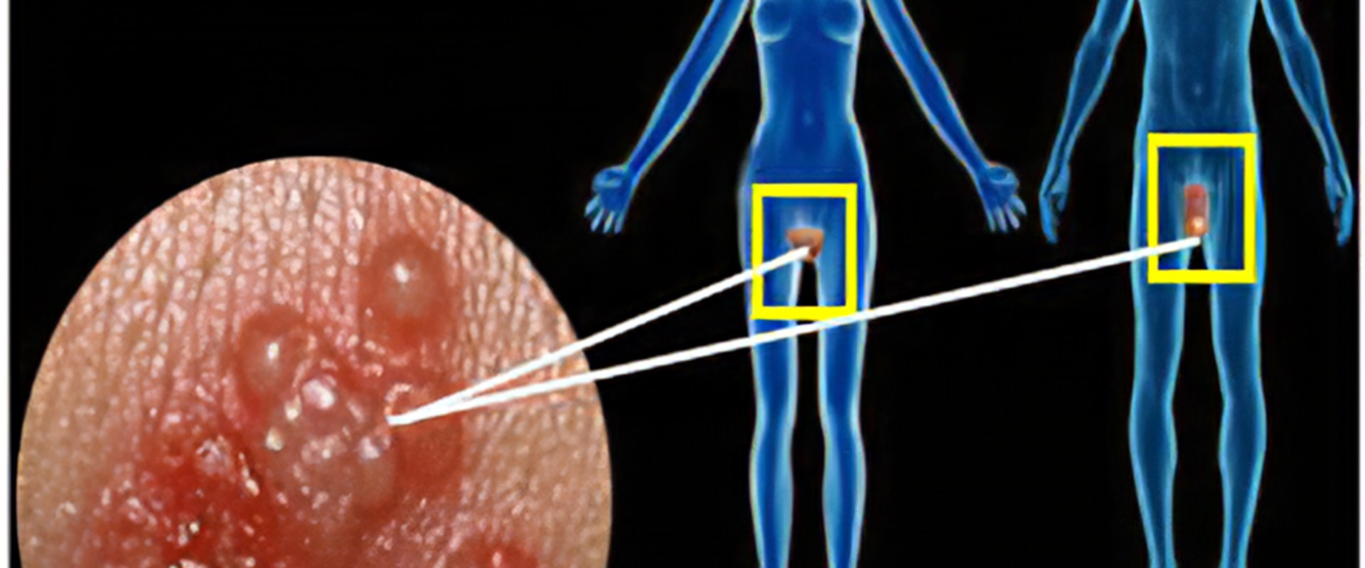 What is the Genital Herpes Cure?