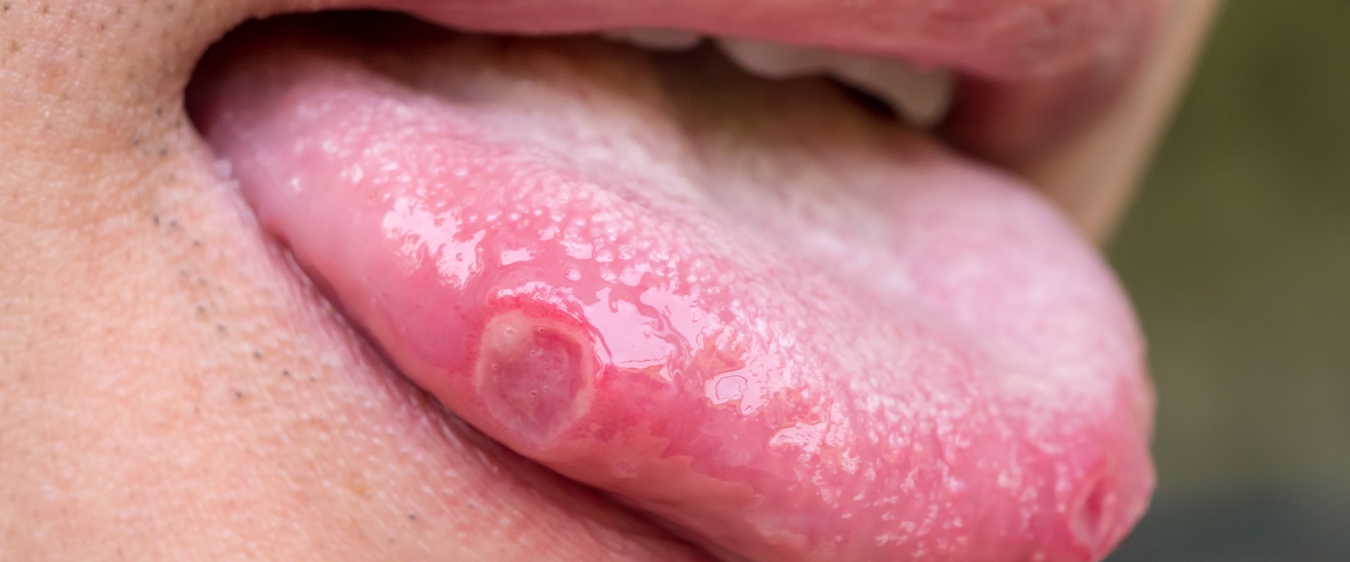 How Long Until Herpes is Cured? A Comprehensive Look at the Latest Research
