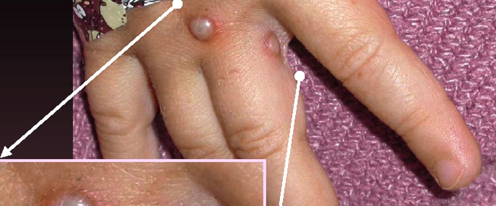 Is Herpes Curable with Antiviral Medications?