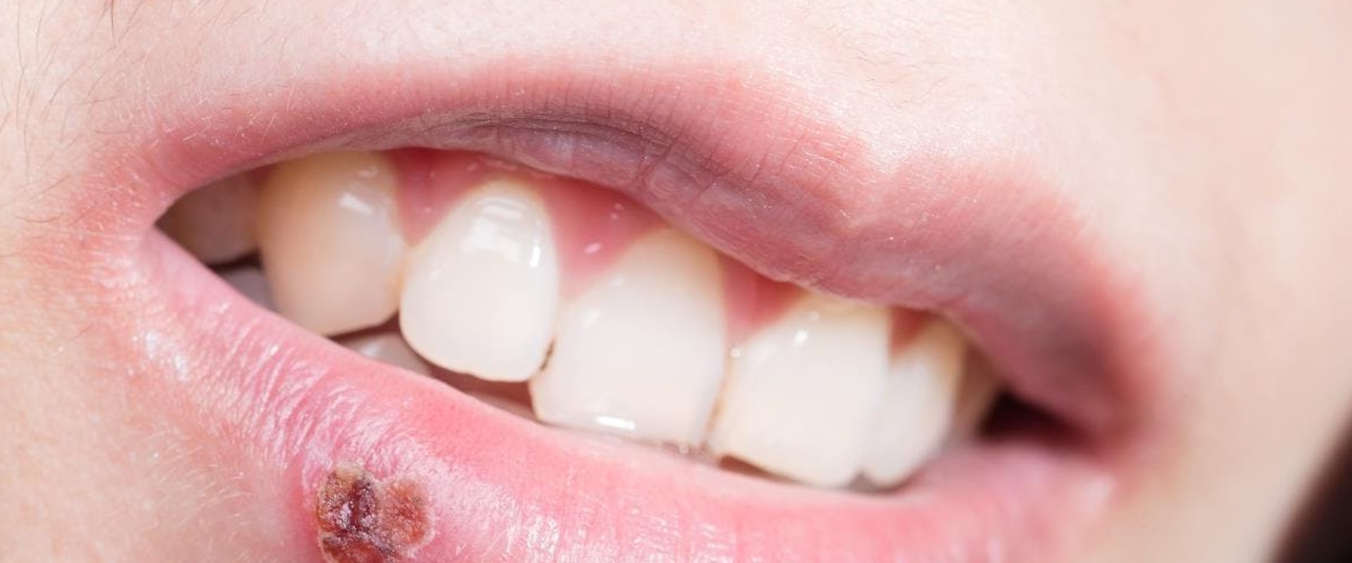 How to Treat Herpes on Lips: A Comprehensive Guide