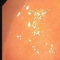 Can Acyclovir Treat Yeast Infections?