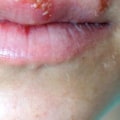 Can Herpes Be Cured? An Expert's Perspective
