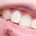 Why Do I Keep Getting Herpes Outbreaks All of a Sudden?