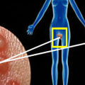 What is the Genital Herpes Cure?