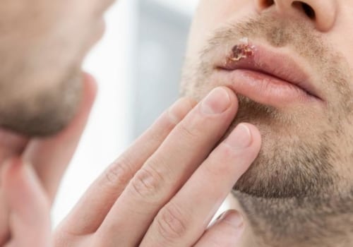 Hope for a Herpes Cure: Exploring the Possibilities