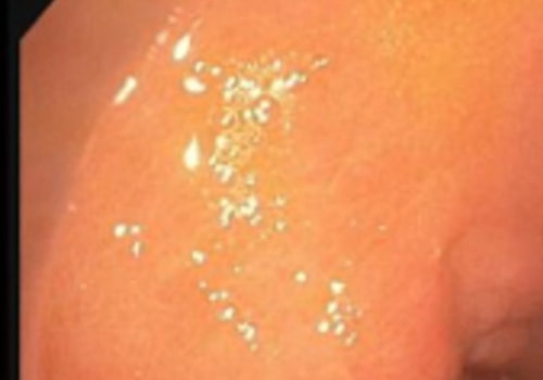 Can Acyclovir Treat Yeast Infections?