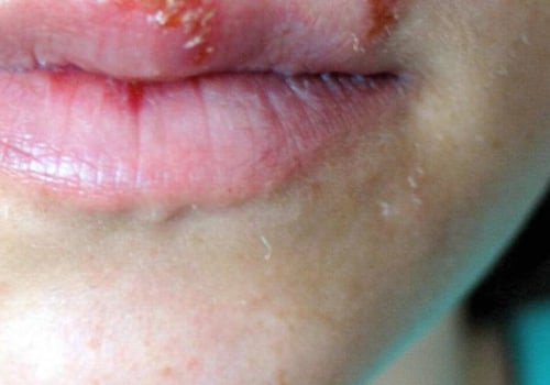 Can Herpes Be Cured? An Expert's Perspective