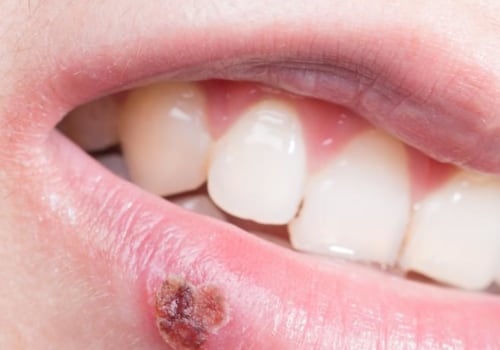 Why Do I Keep Getting Herpes Outbreaks All of a Sudden?