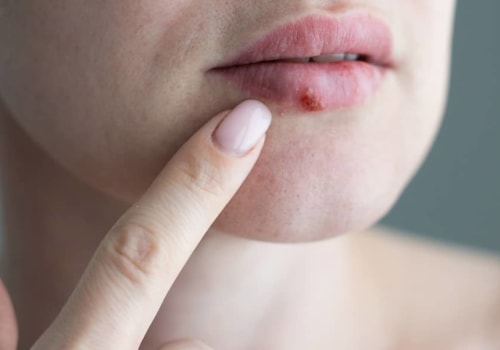 How Long Does Herpes Take to Heal?