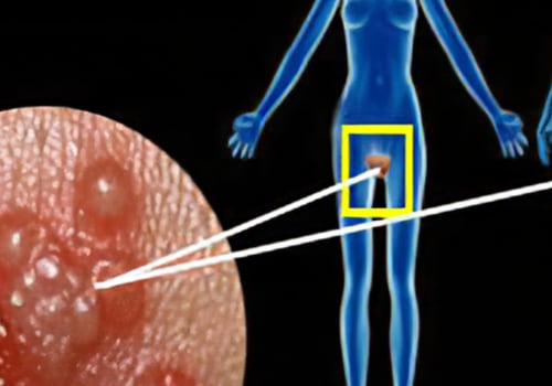 What is the Genital Herpes Cure?