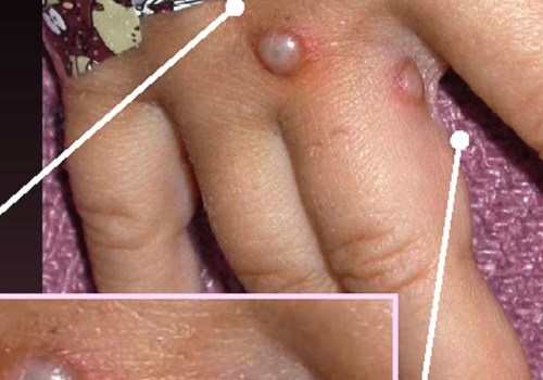 Is Herpes Curable with Antiviral Medications?